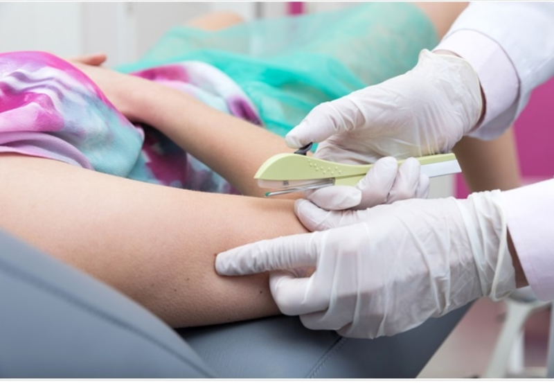 SUS vai oferecer Implanon neste fim de semana: evita gravidez por 3 anos